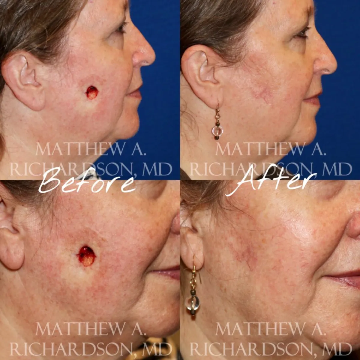 Skin Cancer Reconstruction Performed by Texas Facial Aesthetics