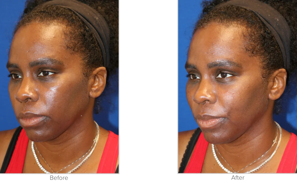 Voluma Before and After Performed by Texas Facial Aesthetics