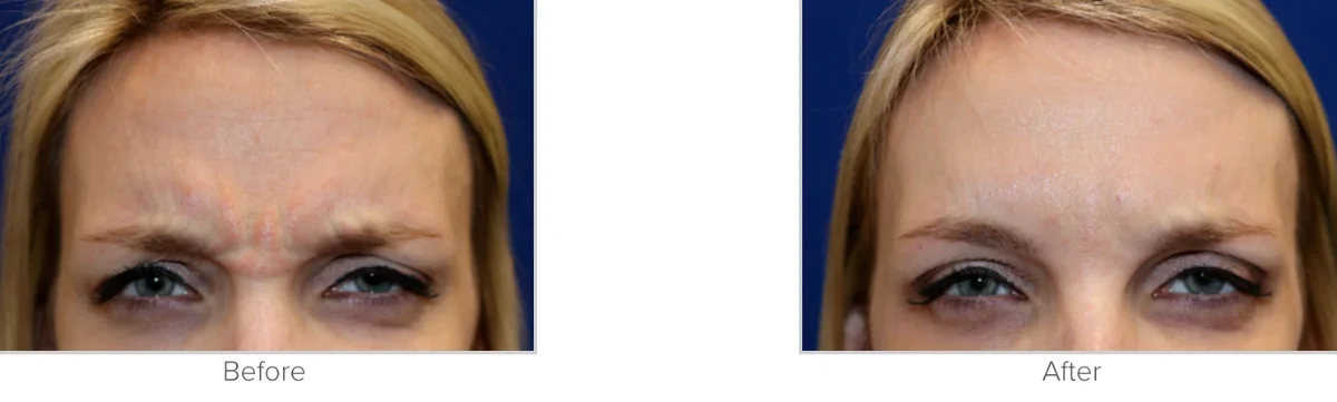 Xeomin Before and After Photos Performed by Texas Facial Aesthetics