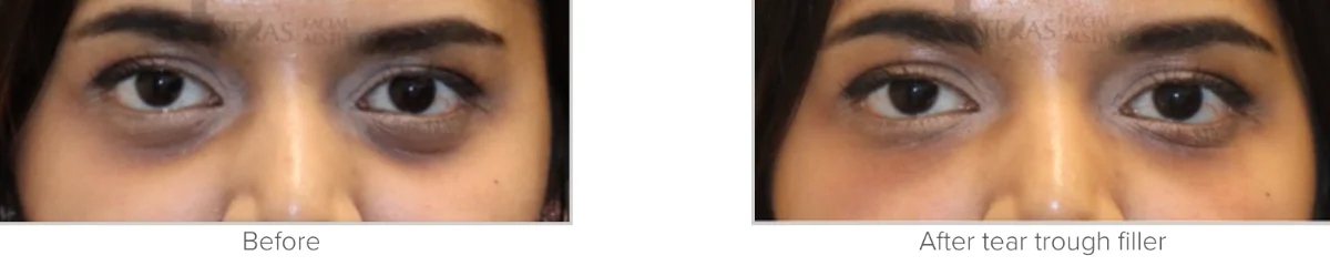 dark eye circles before and after photo performed by Texas Facial Aesthetics