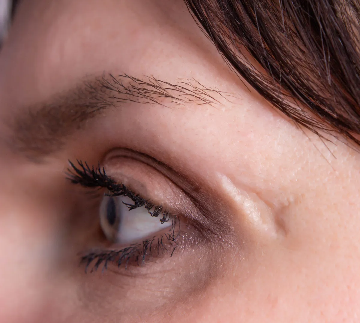 deep scar and scar on the face of the girl near the eye, close up, skin problem, cosmetology