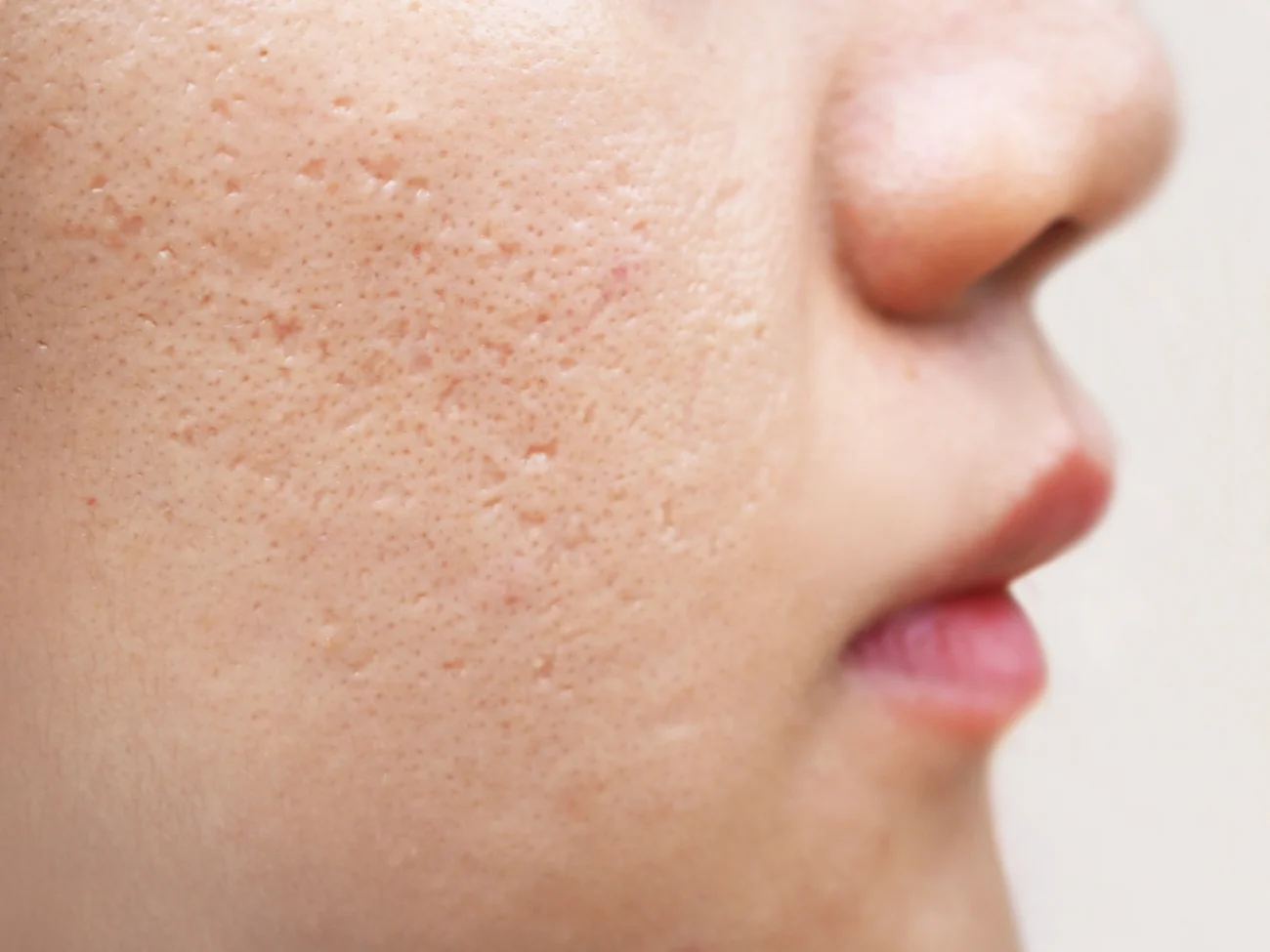 icepick scars acne on cheek on face women cause of happen because of skin loses collagen