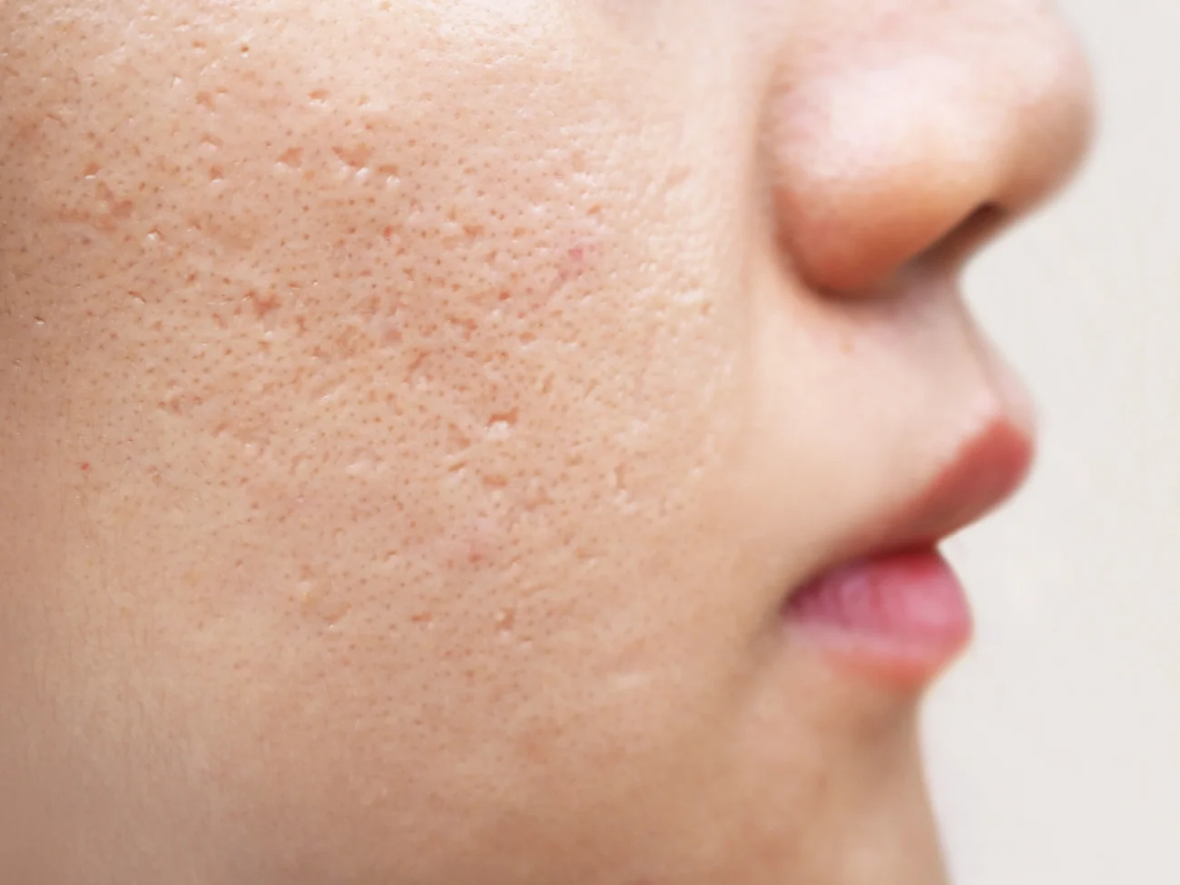 icepick scars acne on cheek on face women cause of happen because of skin loses collagen icepick scars acne on cheek on face women cause of happen because of skin loses collagen