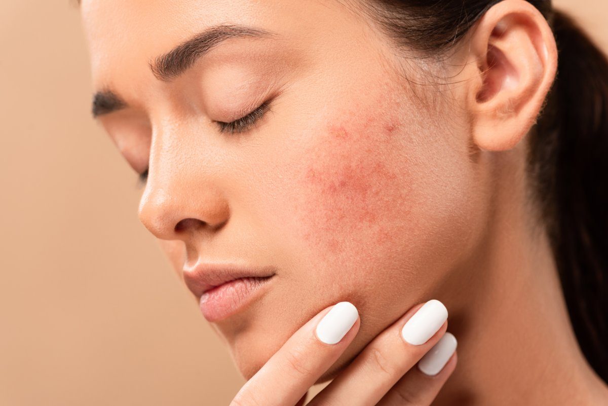 young woman with closed eyes touching face with acne isolated on beige young woman with closed eyes touching face with acne isolated on beige