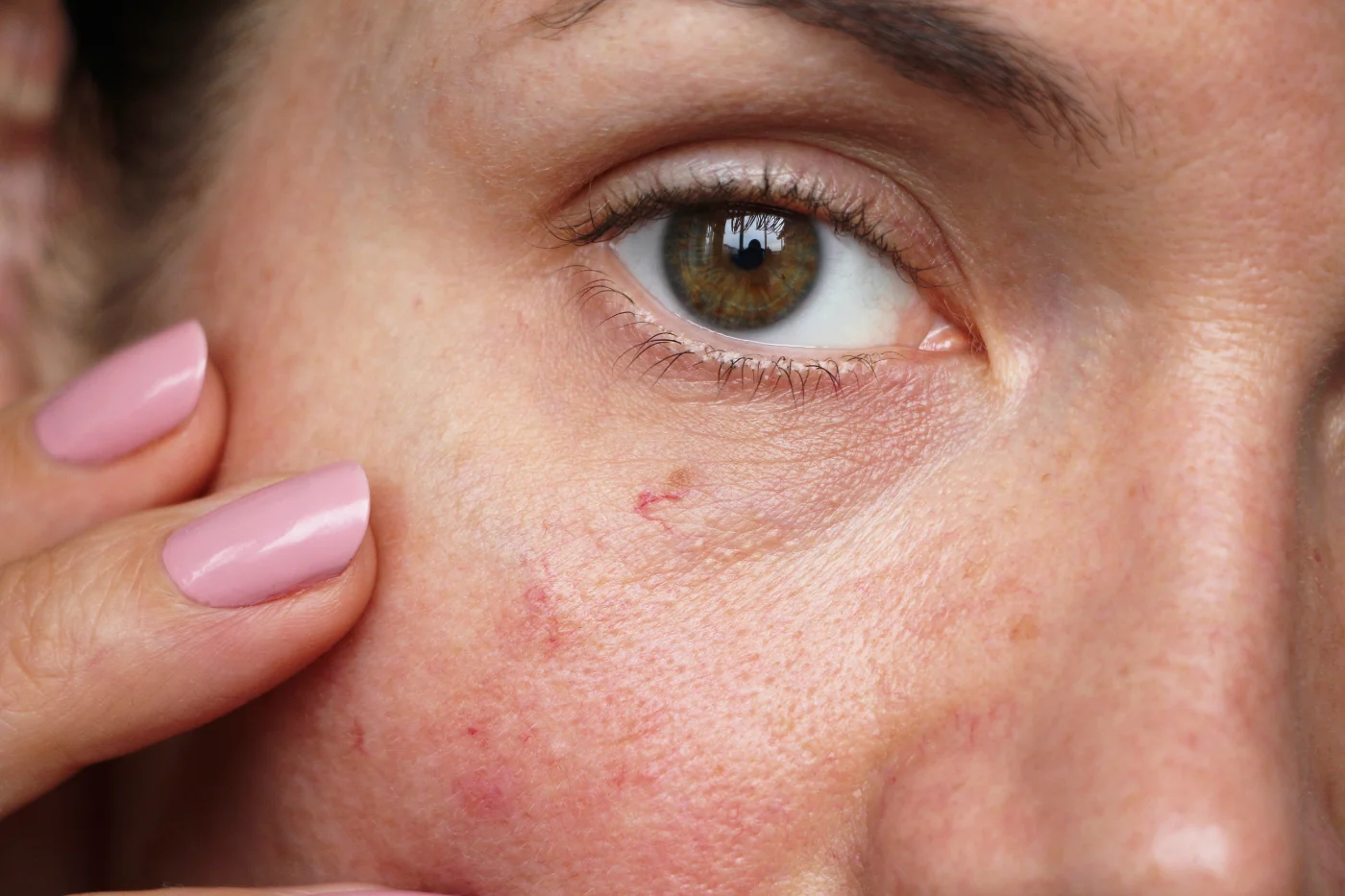 capillaries on the skin of the face,