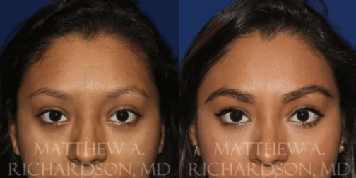 eyebrow transplant before and after performed by Texas Facial Aesthetics
