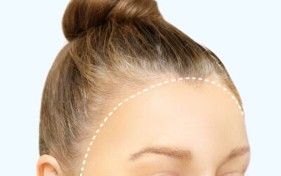 Understanding Hairline Lowering Surgery