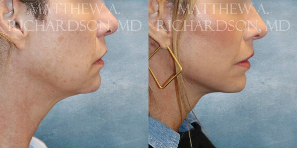 Mini LIft Before and After photo by Texas Facial Aesthetics in Francisco TX