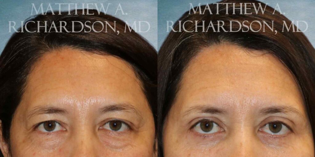 Fat Grafting Before and After photo by Texas Facial Aesthetics in Francisco TX