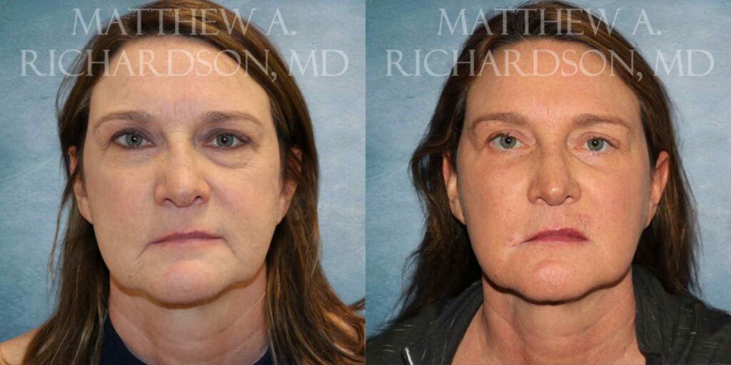 Fat Grafting Before and After photo by Texas Facial Aesthetics in Francisco TX