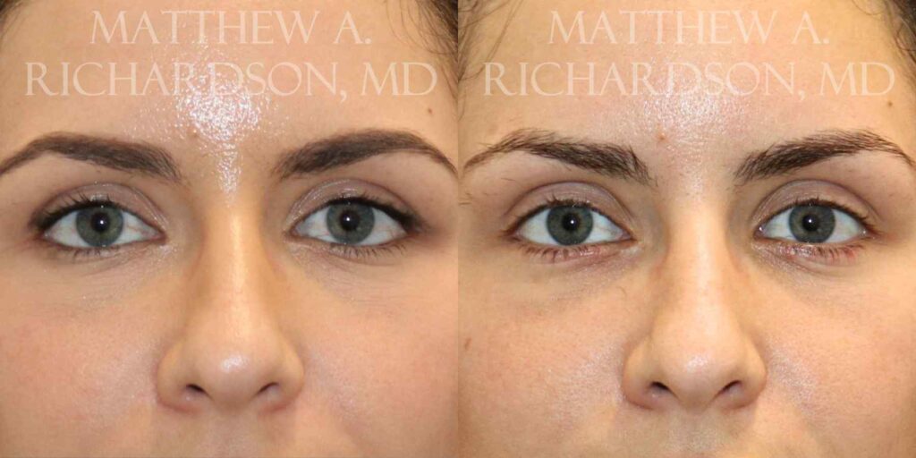 Brow Lift Before and After photo by Texas Facial Aesthetics in Francisco TX