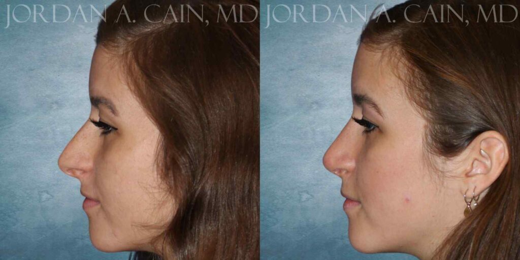 Rhinoplasty Before and After photo by Texas Facial Aesthetics in Francisco TX
