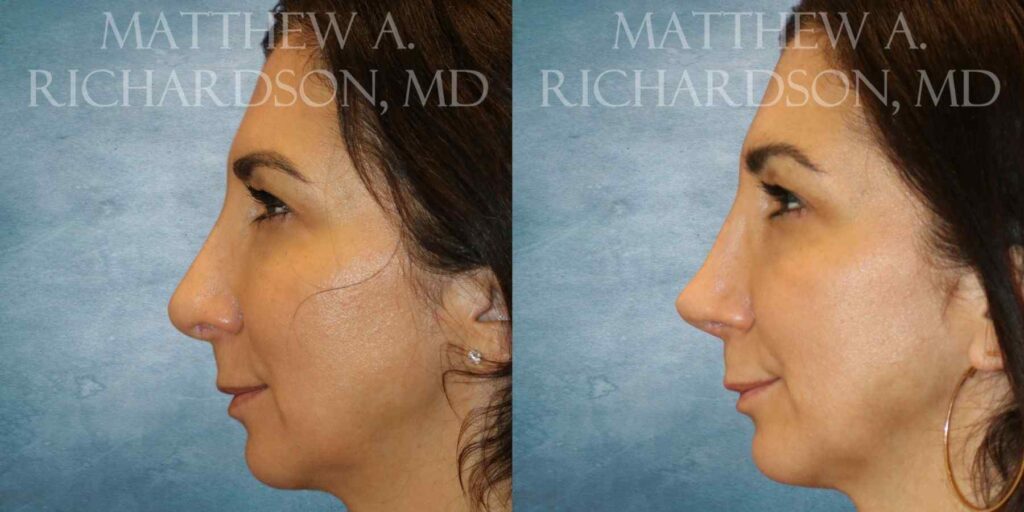 Rhinoplasty Before and After photo by Texas Facial Aesthetics in Francisco TX