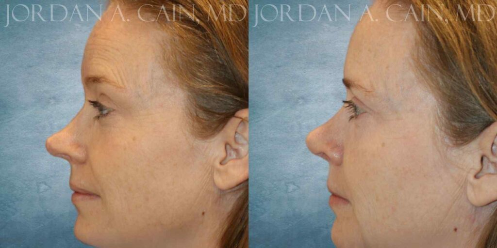 Rhinoplasty Before and After photo by Texas Facial Aesthetics in Francisco TX