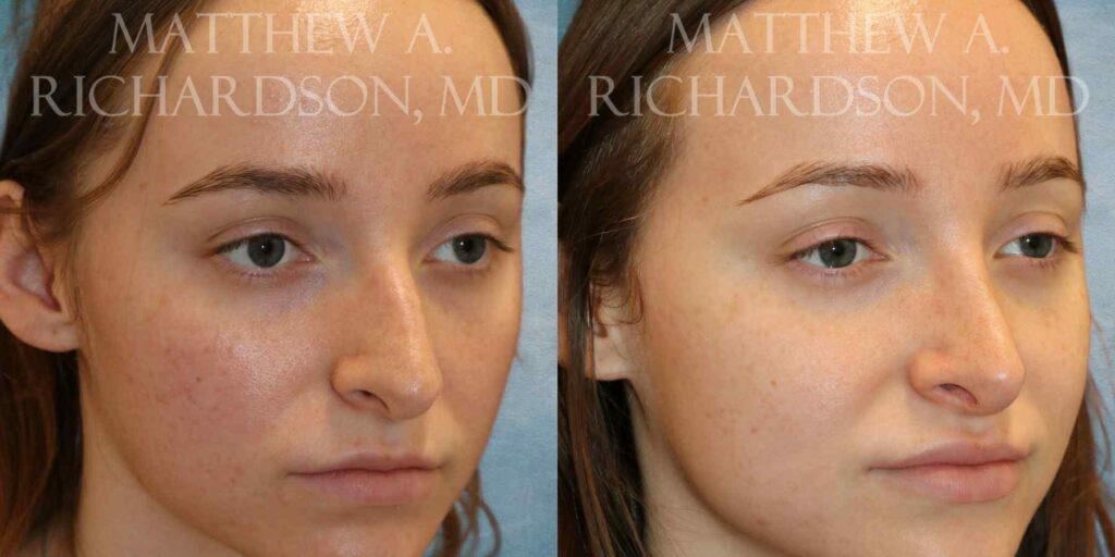 Rhinoplasty Before and After photo by Texas Facial Aesthetics in Francisco TX