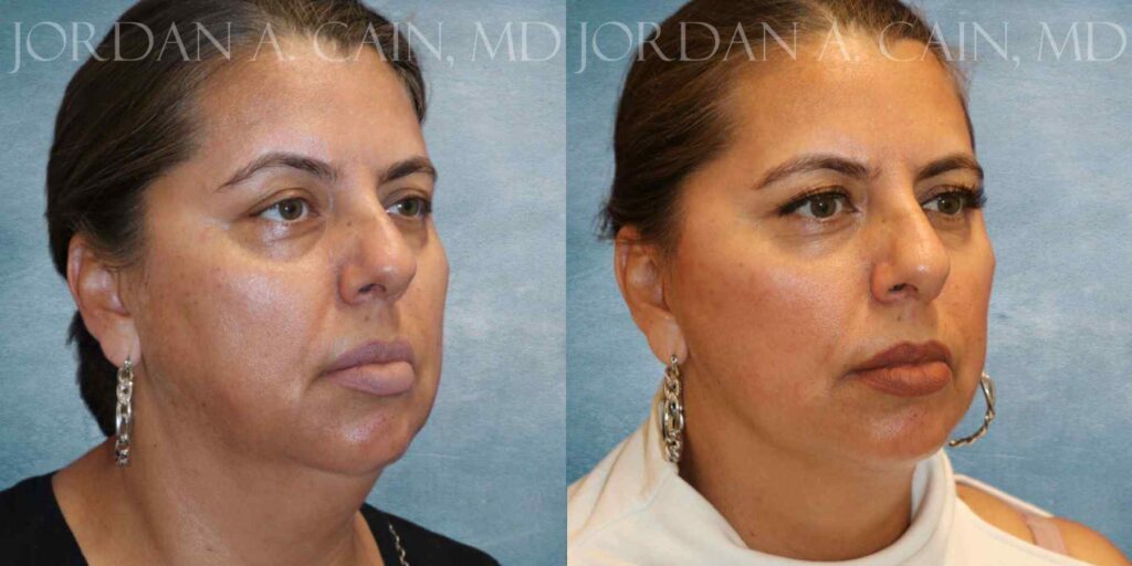 Facelift Before and After photo by Texas Facial Aesthetics in Francisco TX
