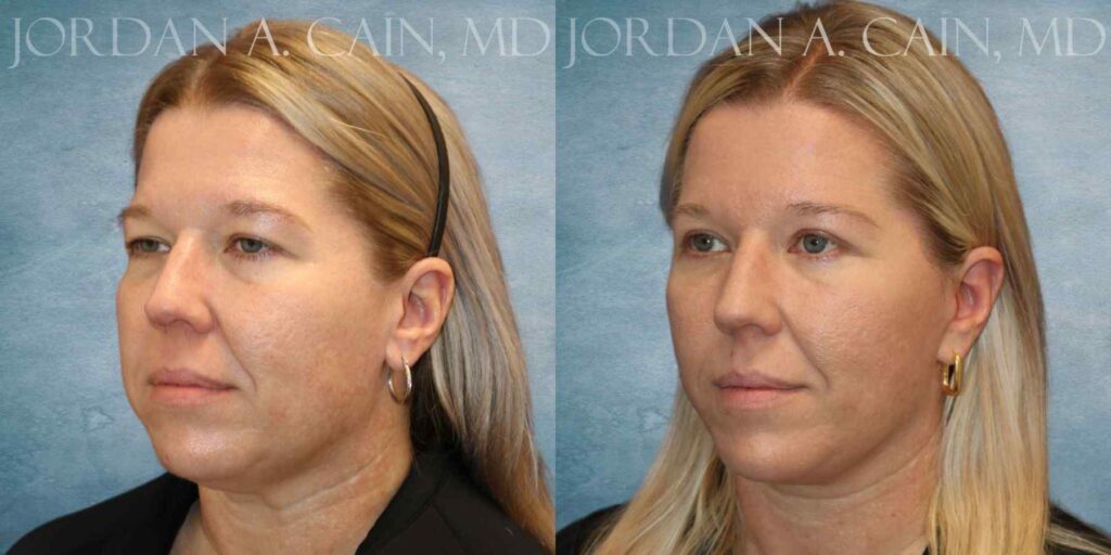 Facelift, Necklift & Fat Grafting Before and After photo by Texas Facial Aesthetics in Francisco TX