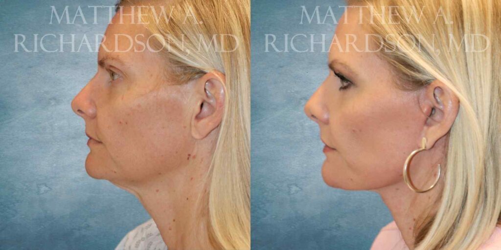Mini LIft Before and After photo by Texas Facial Aesthetics in Francisco TX