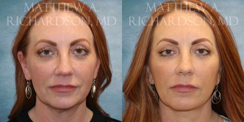 Mini LIft and Fat Grafting Before and After photo by Texas Facial Aesthetics in Francisco TX