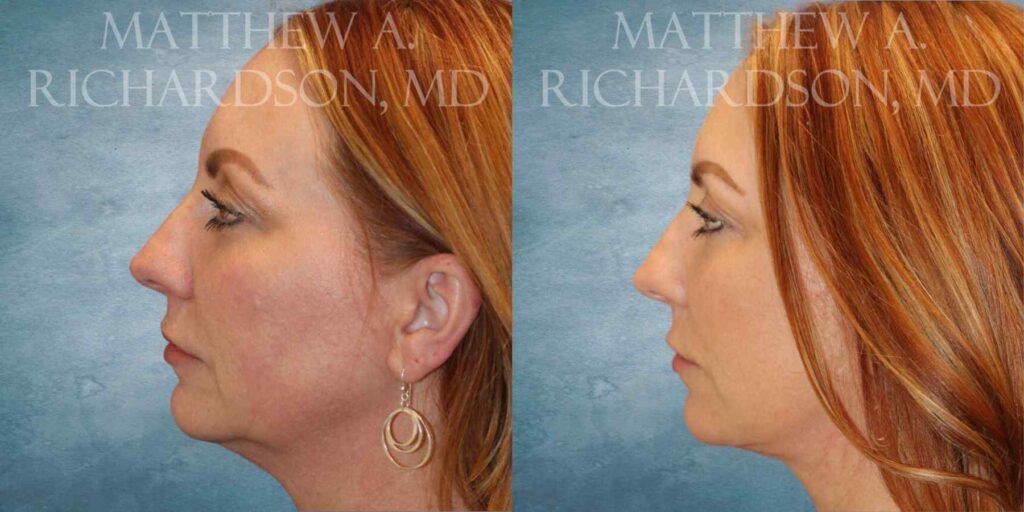 Mini LIft and Fat Grafting Before and After photo by Texas Facial Aesthetics in Francisco TX