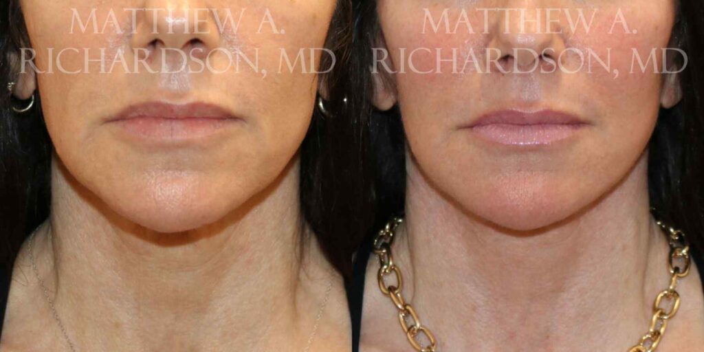 Facelift and Fat Grafting Before and After photo by Texas Facial Aesthetics in Francisco TX