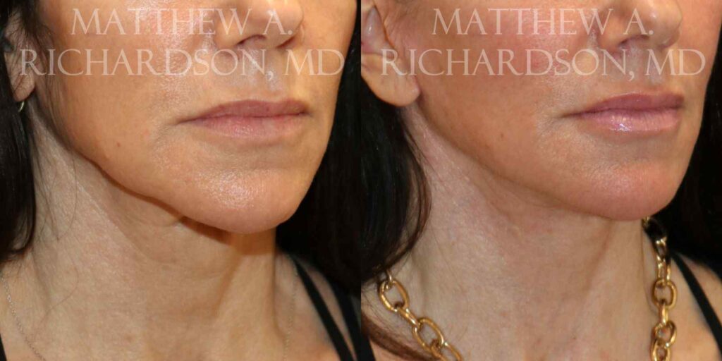 Facelift and Fat Grafting Before and After photo by Texas Facial Aesthetics in Francisco TX