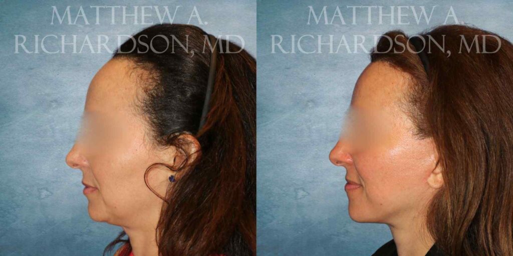 Mini Lift Before and After photo by Texas Facial Aesthetics in Francisco TX