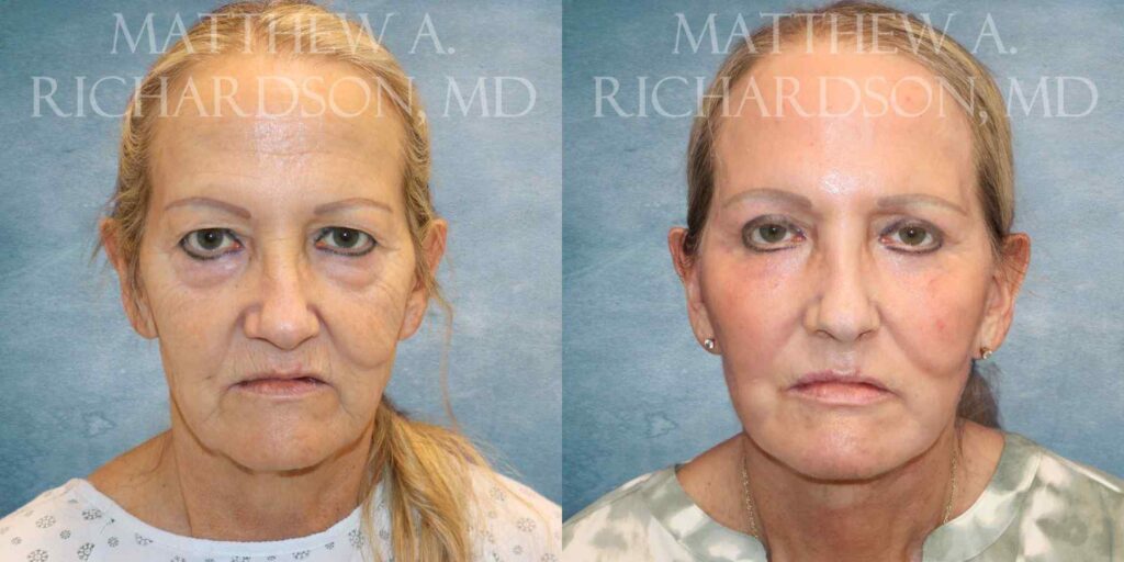 Facelift, Chemical Peel & Fat Grafting Before and After photo by Texas Facial Aesthetics in Francisco TX