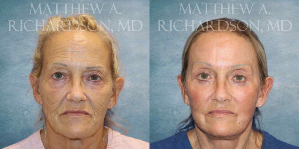Facelift, Chemical Peel & Fat Grafting Before and After photo by Texas Facial Aesthetics in Francisco TX