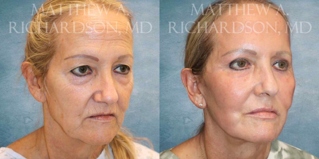 Facelift, Chemical Peel & Fat Grafting Before and After photo by Texas Facial Aesthetics in Francisco TX