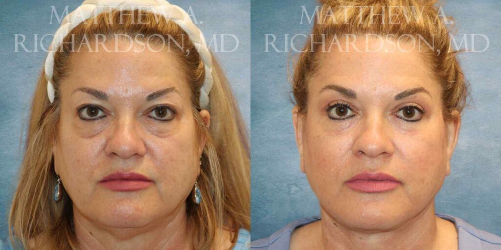 Facelift, Fat Grafting & CO Laser Before and After photo by Texas Facial Aesthetics in Francisco TX