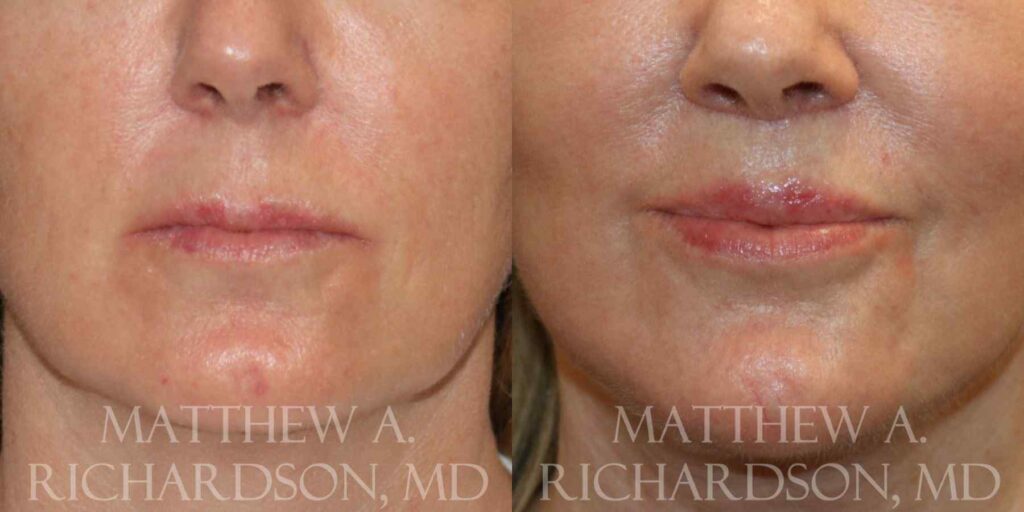 Lip Lift Before and After photo by Texas Facial Aesthetics in Francisco TX