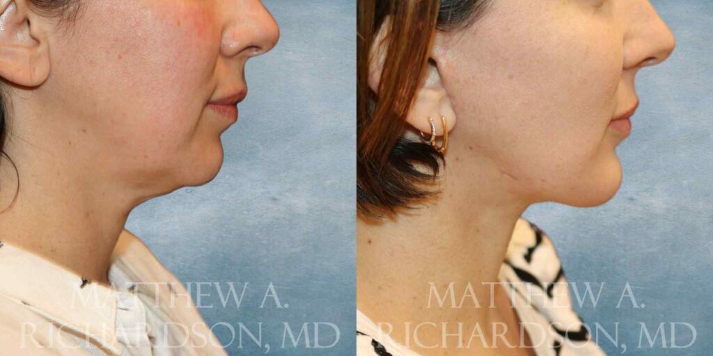 Buccal Fat Reduction & Chin Augmentation Before and After photo by Texas Facial Aesthetics in Francisco TX