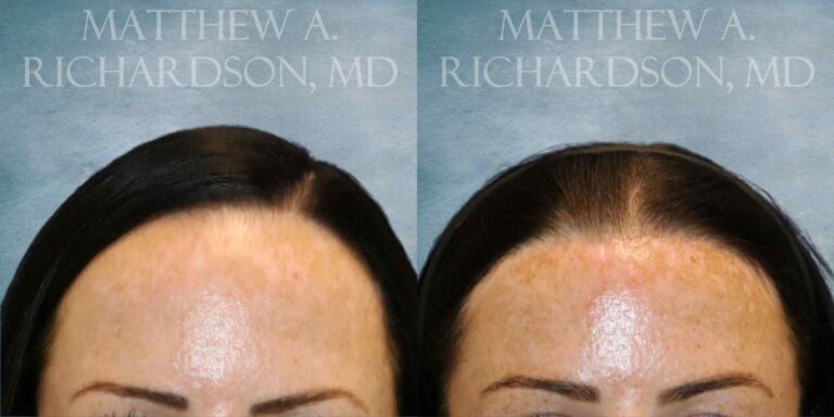 Forehead Reduction Before and After photo by Texas Facial Aesthetics in Francisco TX