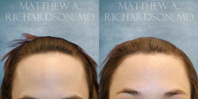 Forehead Reduction Before and After photo by Texas Facial Aesthetics in Francisco TX