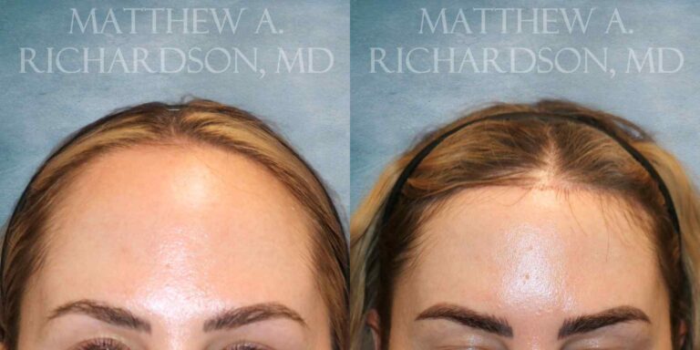 Forehead Reduction Before and After photo by Texas Facial Aesthetics in Francisco TX