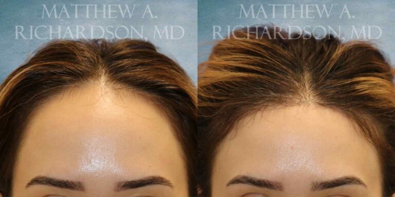Forehead Reduction Before and After photo by Texas Facial Aesthetics in Francisco TX