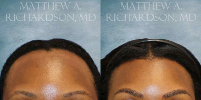 Forehead Reduction Before and After photo by Texas Facial Aesthetics in Francisco TX