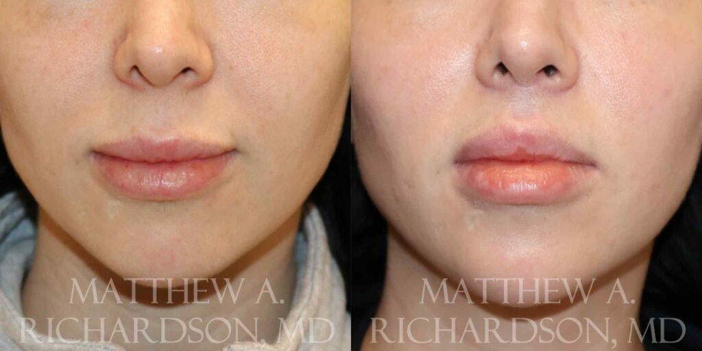 Lip Lift Before and After photo by Texas Facial Aesthetics in Francisco TX