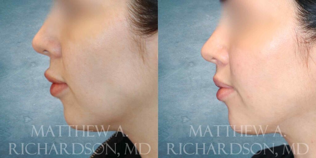 Lip Lift Before and After photo by Texas Facial Aesthetics in Francisco TX