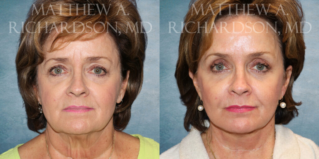 Neck Lift Before and After photo by Texas Facial Aesthetics in Frisco TX