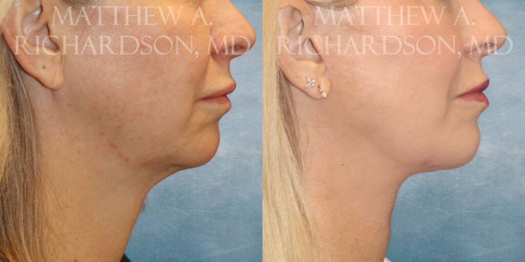 Minilift Before and After photo by Texas Facial Aesthetics in Francisco TX