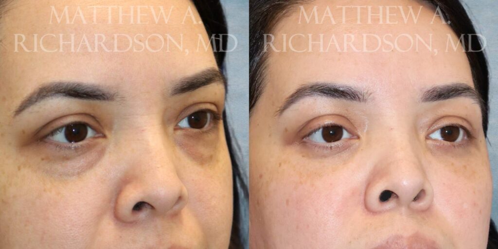 Fat Injection Before and After photo by Texas Facial Aesthetics in Francisco TX