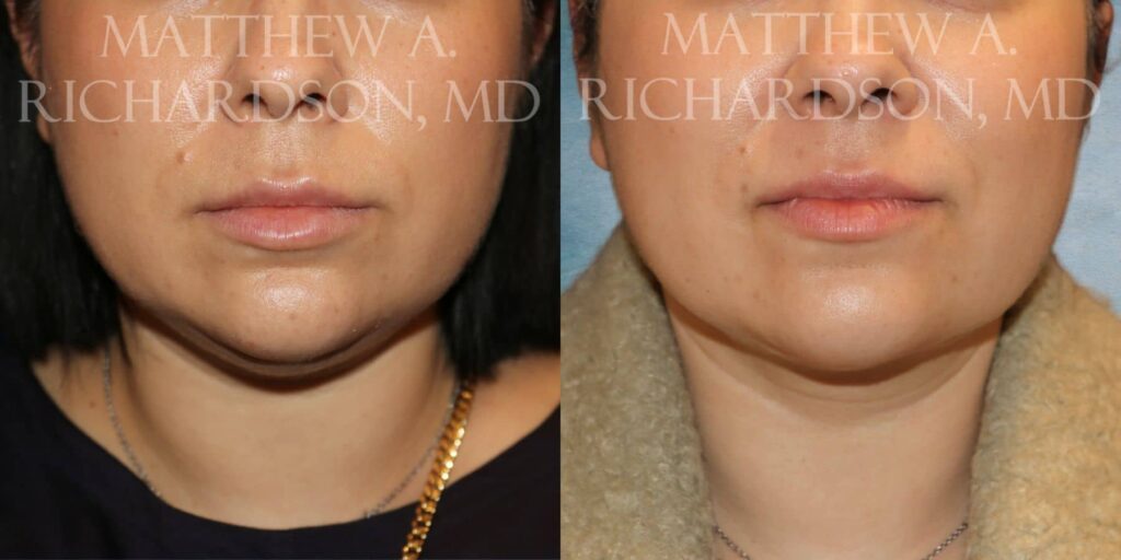 Neck Liposuction Before and After photo by Texas Facial Aesthetics in Francisco TX