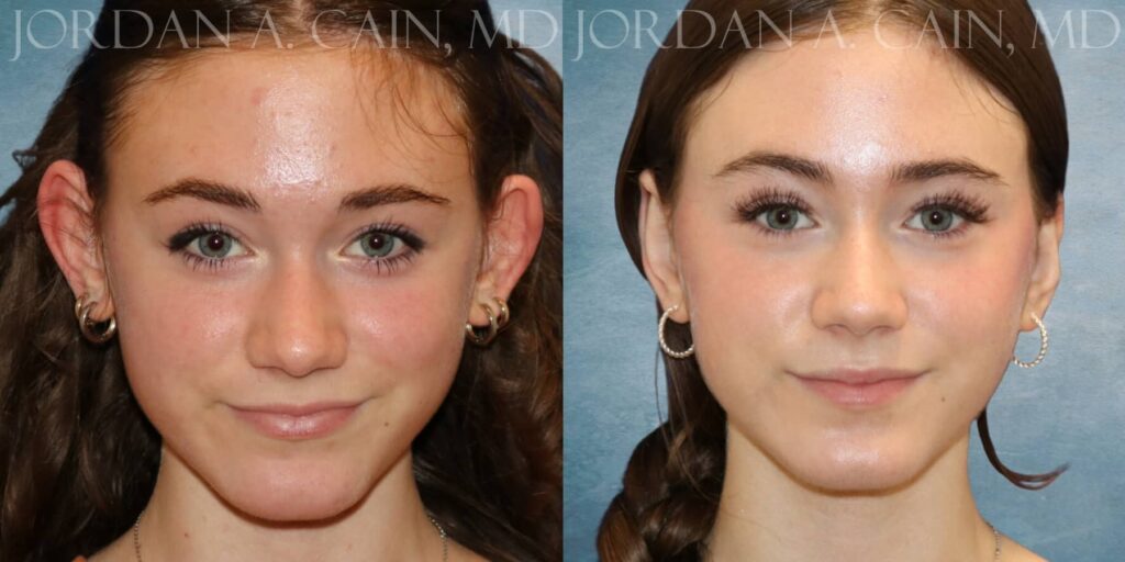 Otoplasty Before and After photo by Texas Facial Aesthetics in Francisco TX