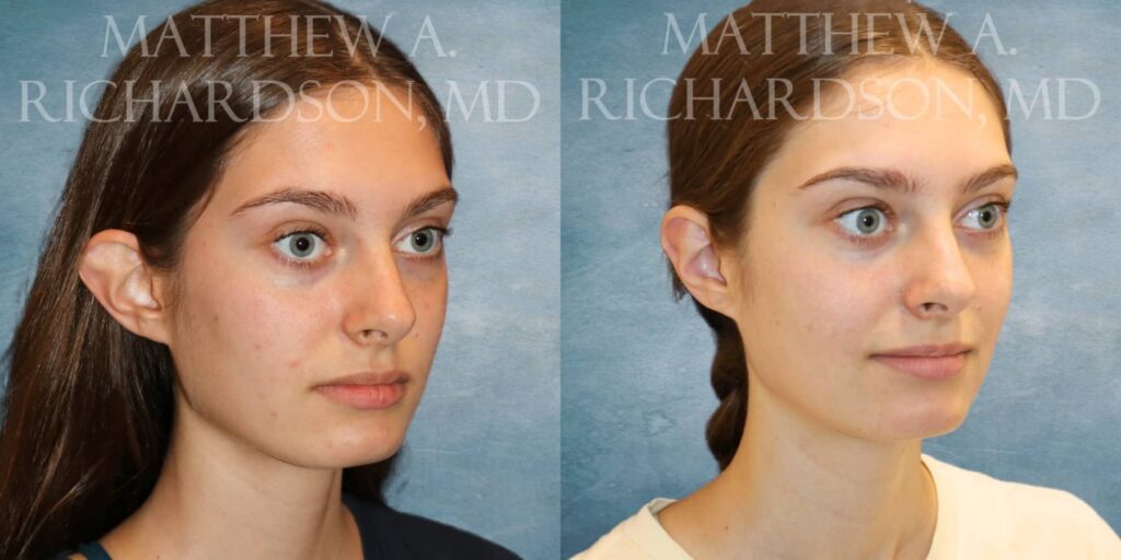 Otoplasty Before and After photo by Texas Facial Aesthetics in Francisco TX