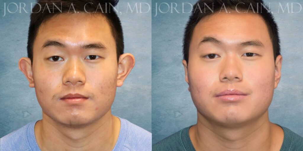 Otoplasty Before and After photo by Texas Facial Aesthetics in Francisco TX