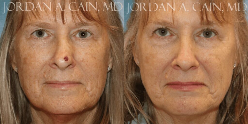MOHS Repair Before and After photo by Texas Facial Aesthetics in Francisco TX