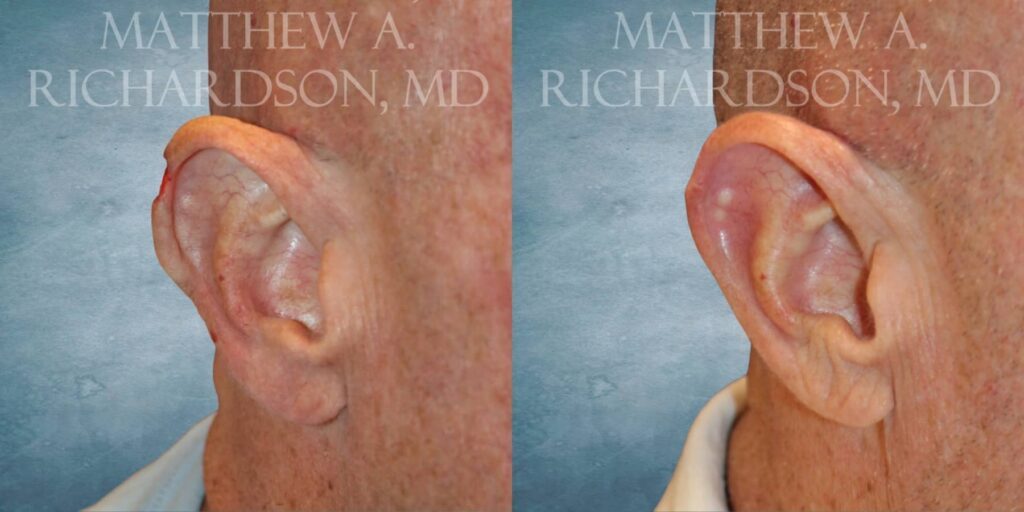 MOHS Repair Before and After photo by Texas Facial Aesthetics in Francisco TX