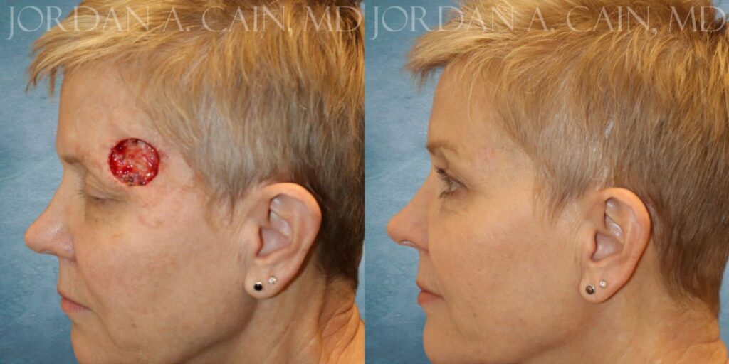 MOHS Repair Before and After photo by Texas Facial Aesthetics in Francisco TX